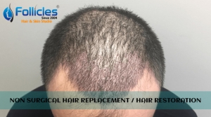 Hair restoration treatment in Hyderabad