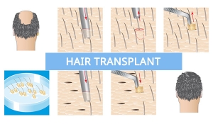 Know the best Hair Transplant In Delhi-India