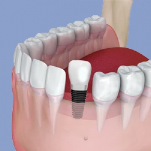 Dental Implants in Hyderabad