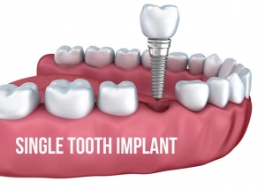 Low Cost Tooth Implant in India - Smile Delhi The Dental Cli