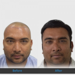 Best Hair Loss Treatment Clinic in Ahmedabad - Facial Virtuo
