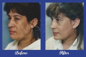 Anti-aging Treatments  in Vizag
