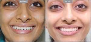 Tooth pain treatment in Indore | Smile makeover treatment