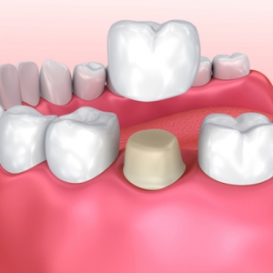 Dental Implantology Courses And Dental Implant Courses in In