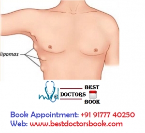 Lipoma Removal Doctor in Hyderabad | Lipoma Removal Surgeon