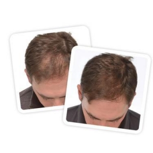 iGrow-Hair Regrowth Is Possible