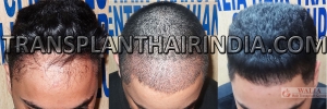 Hair Transplant to treat hair loss in India-WH