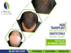Cost of hair transplant in bangalore