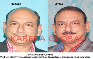 Restore Hair from Best Hair Transplant Clinic in Punjab