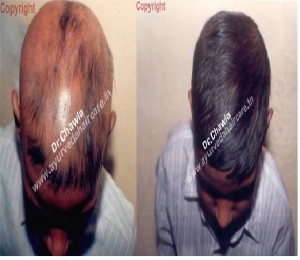 Alopecia Universalis in India 