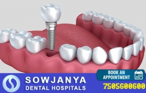Dental Hospital in Hyderabad | Dental Hospital in Himayat Na