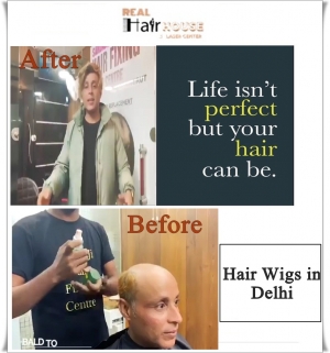 Hair Patch in Gurgaon