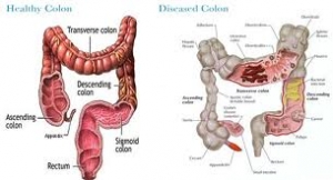 Detoxification / Colon Cleansing Therapy In Mumbai