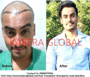 Seek Advanced Hair Treatment at affordable Cost in Jalandhar