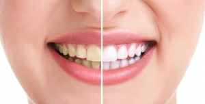dental clinic for dental implants|dental clinic for braces|d