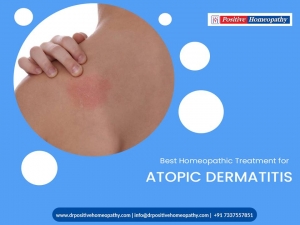  Best Homeopathy Treatment for Atopic dermatitis in hyderbad