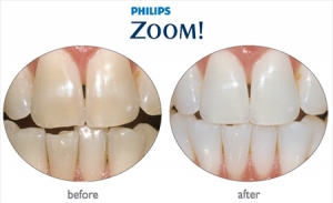 Get low dental filling cost to repair chipped or fractured t