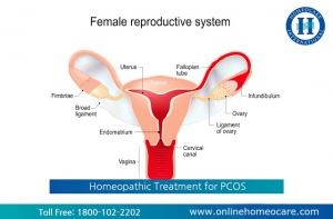 PCOS Treatment in Homeopathy