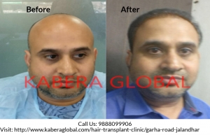 Ideal Hair Transplant Clinic in Punjab for Hair Restoration
