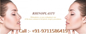 Rhinoplasty in India