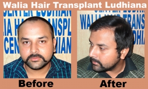 Best Hair Transplant Ludhiana Center in India 