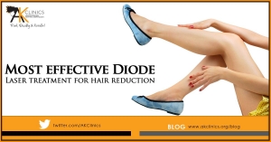 Laser Hair removal in Delhi at affordable cost