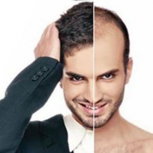 Hair transplant is the solution to all your hair fall issues