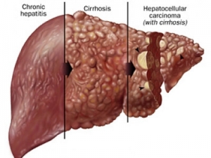 Liver treatment in India
