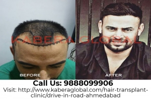 Reinvent Looks by Best Hair Transplant Clinic in Ahmedabad