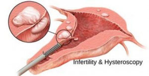 Hysteroscopy and Infertility | Visit us To Know More