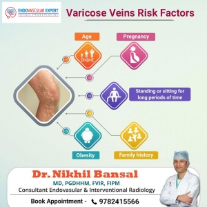 Risk factors of varicose veins