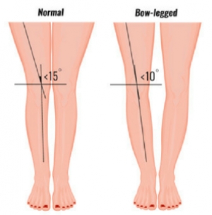 Bow Legs Surgery|Bone And Joint Care Center