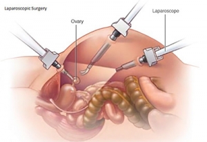 Laparoscopic Surgery for Infertility
