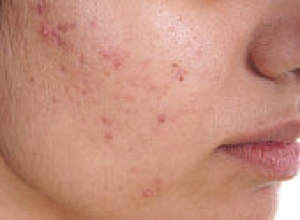 Best Homeopathic Treatment for Acne- Homeopathy4all