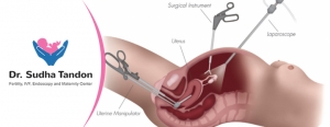 Laparoscopic Hysterectomy in India | Laparoscopic Hysterecto