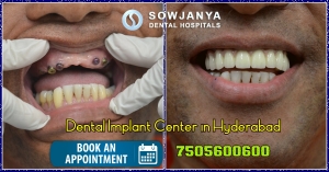Dental Implants in Hyderabad | Best Cosmetic Dentist in Hyde